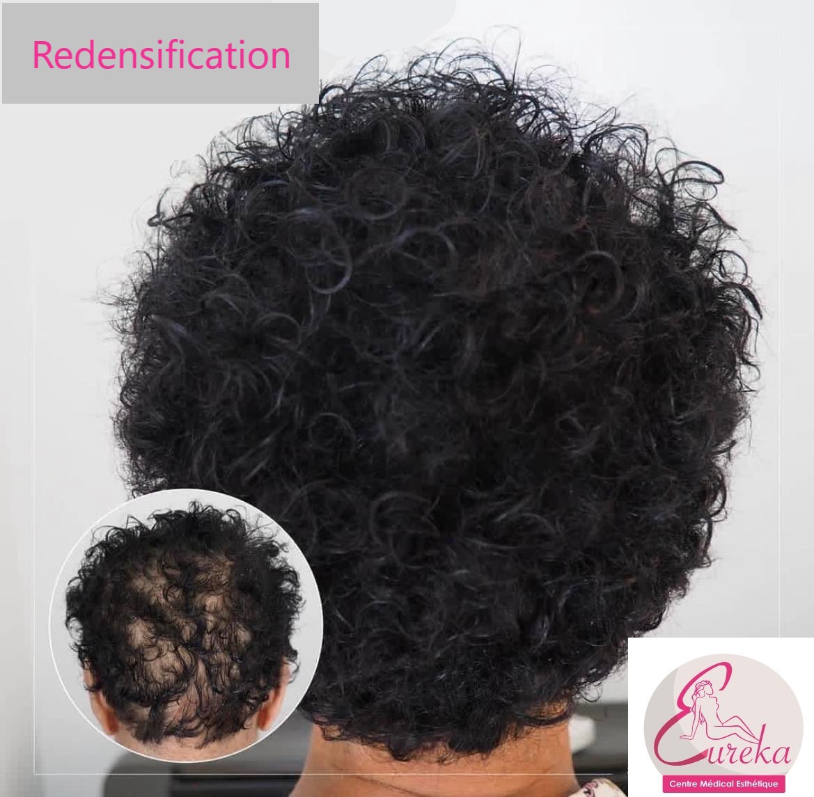 Dermopigmentation - photo 5