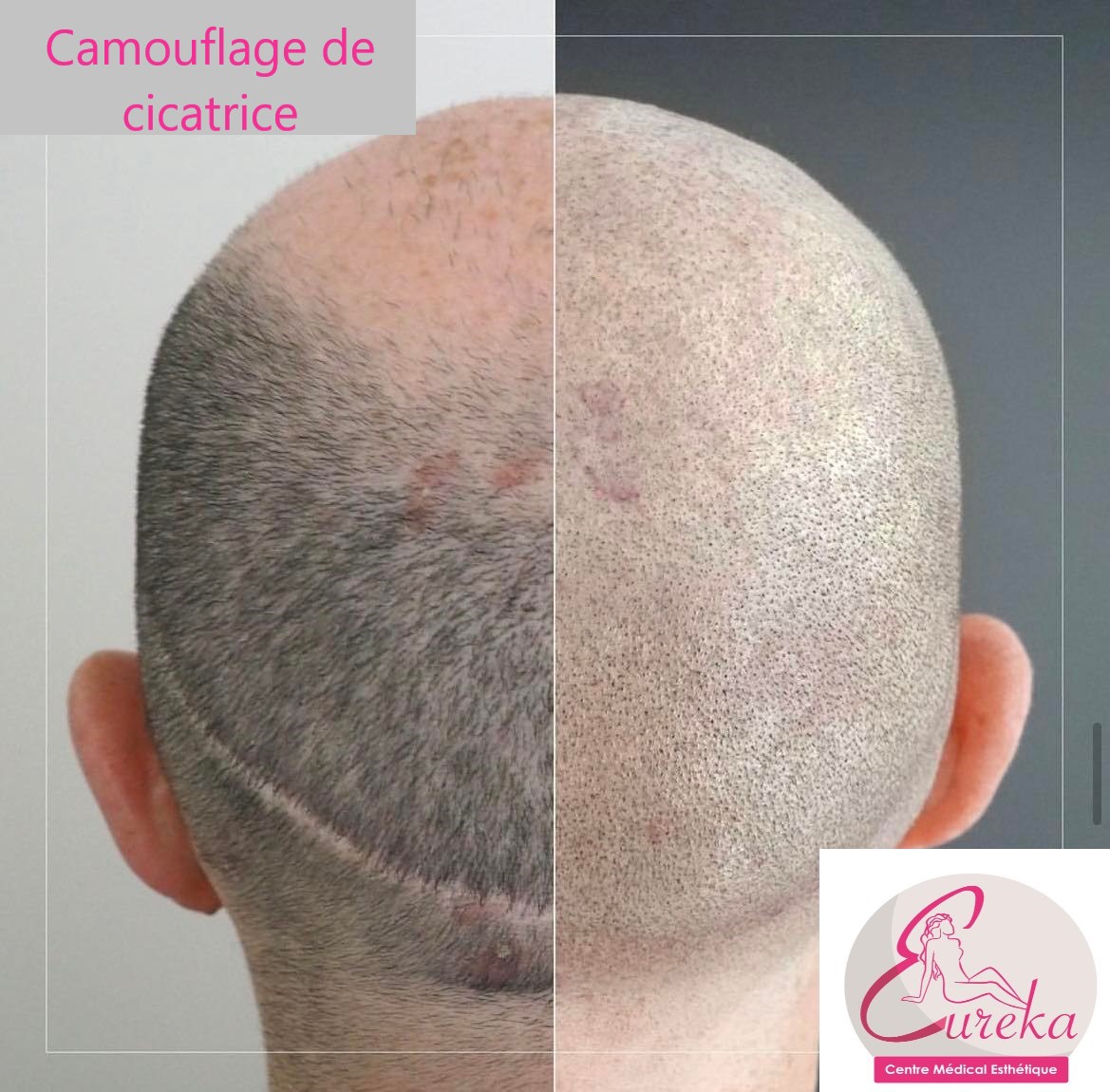 Dermopigmentation - photo 6