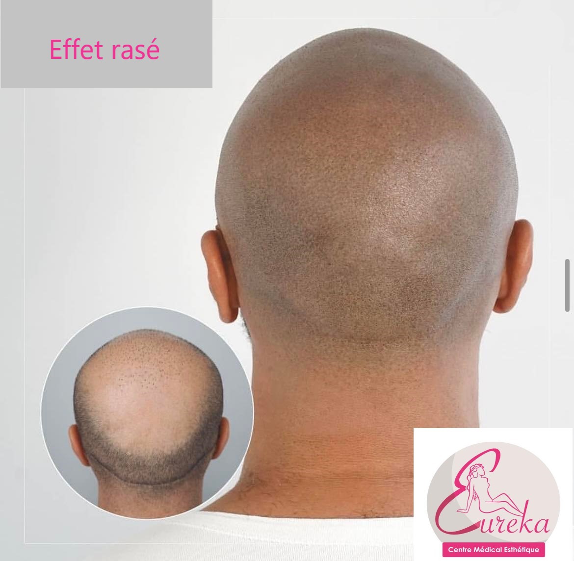 Dermopigmentation - photo 4